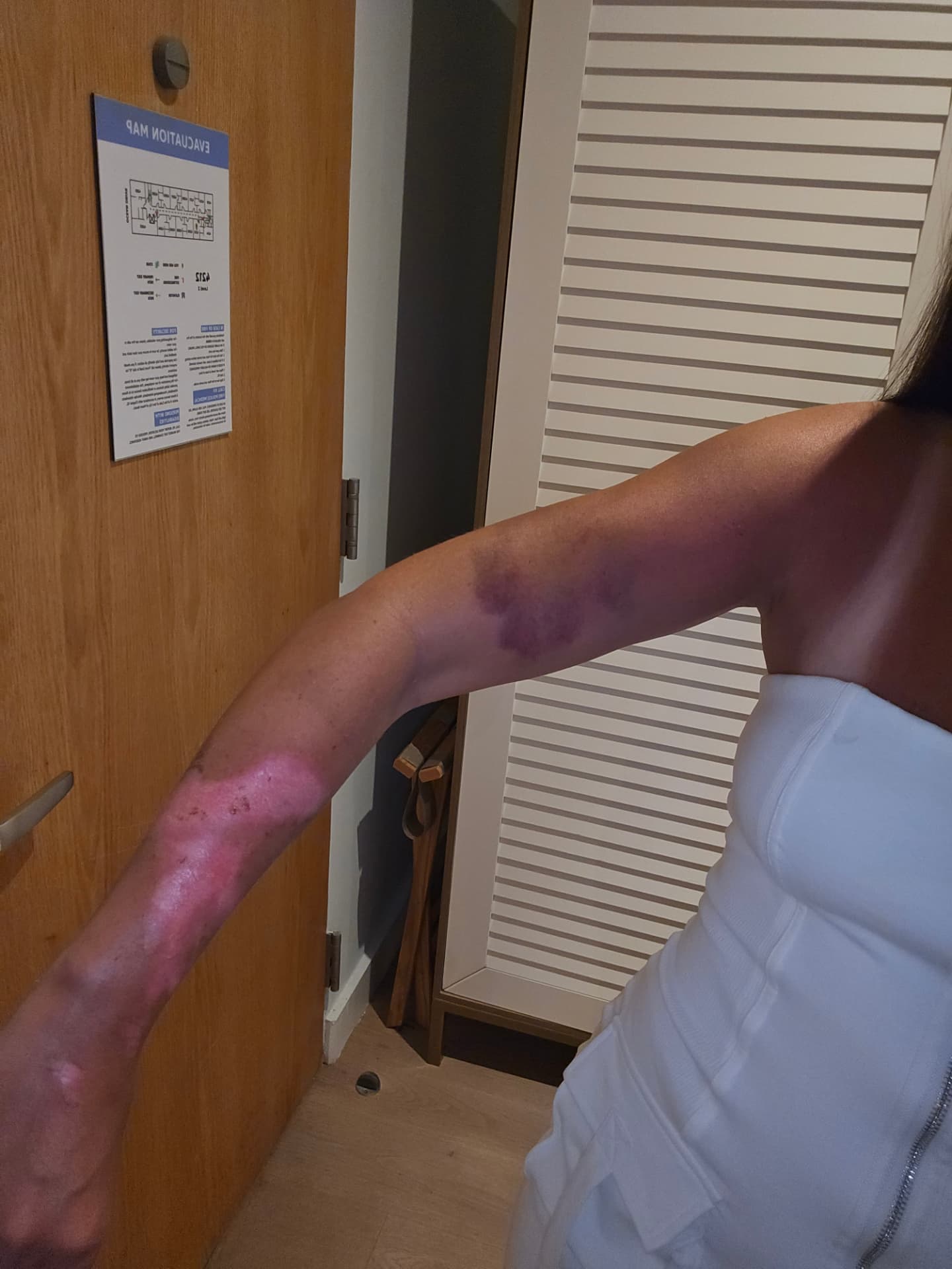 Nikki's arm showing bruised and scraped catfish-bite marks.