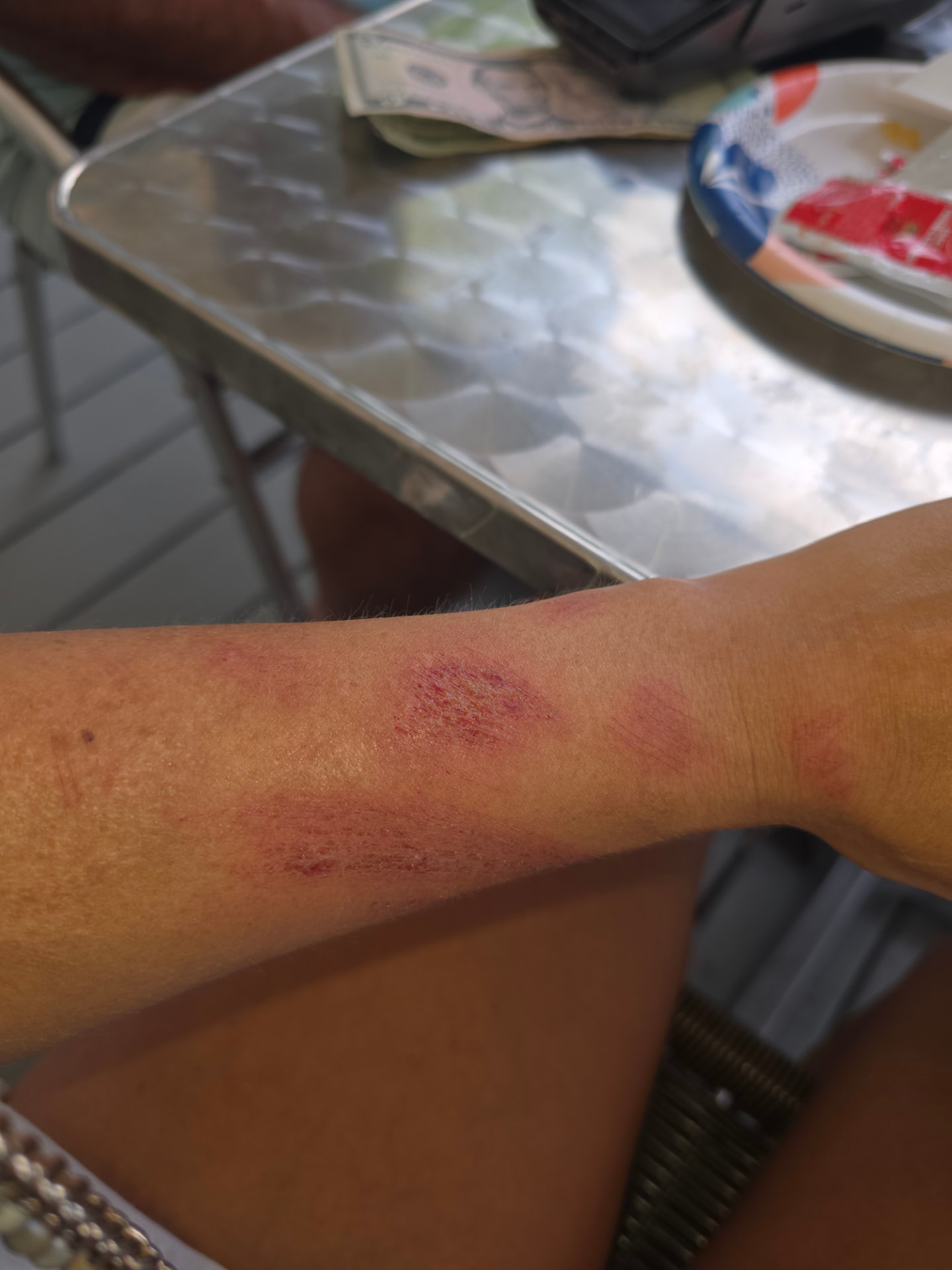 Red catfish-bite marks on Nikki's forearm resting on a metal table.