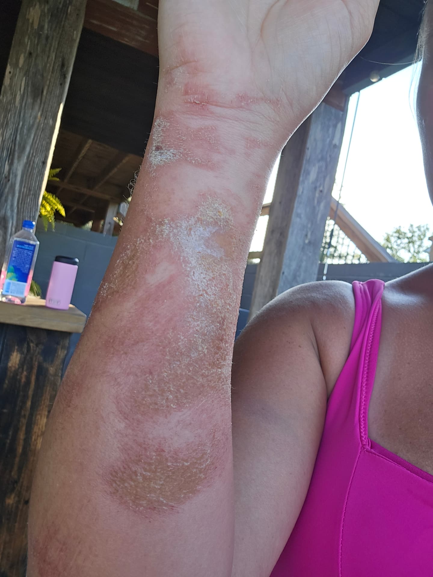 Nikki's forearm covered in healing catfish-bite abrasions.