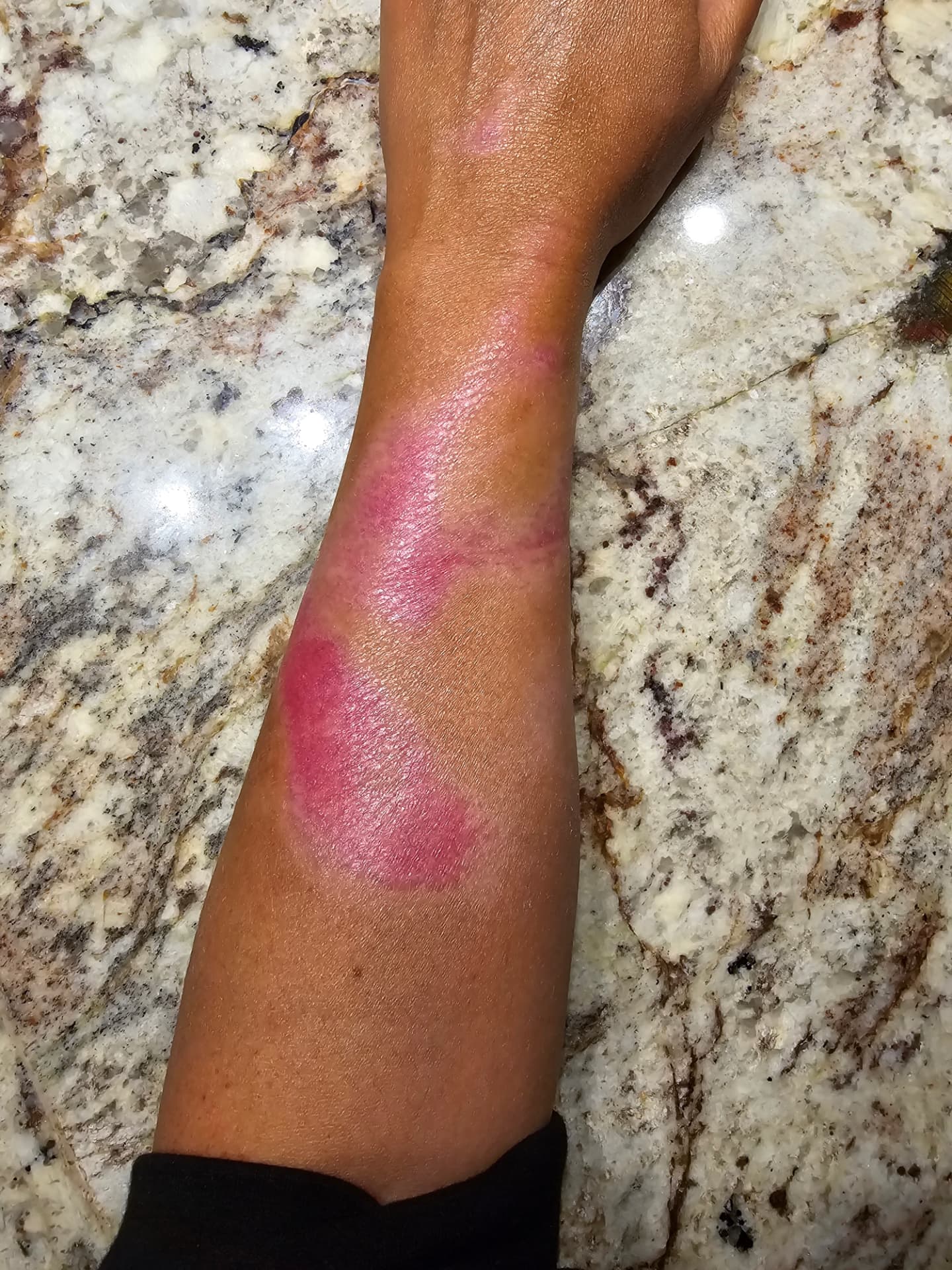 Pink catfish-bite marks along Nikki's forearm against a granite counter.